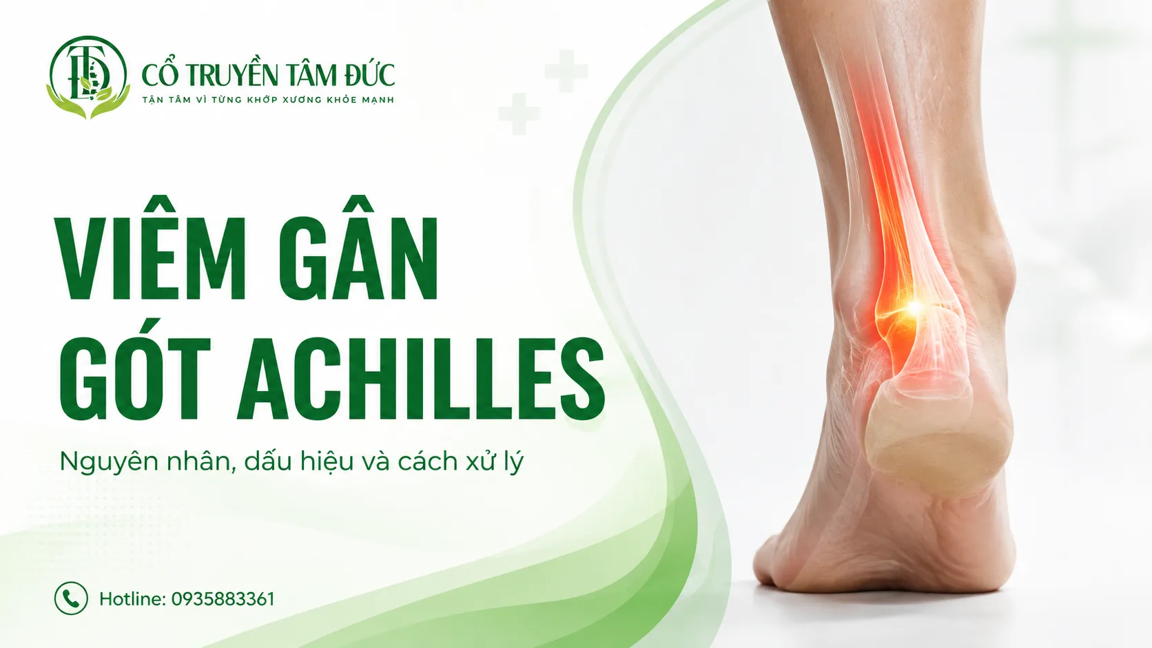 Viêm gân gót Achilles: Nguyên nhân, triệu chứng và cách xử lý
