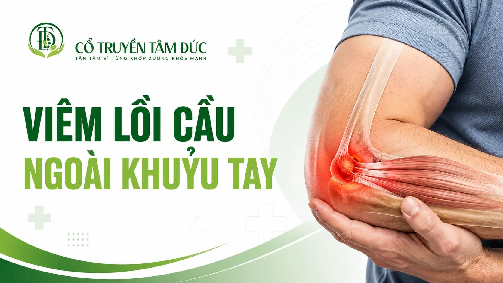 Viêm điểm bám gân lồi cầu ngoài khuỷu tay: Dấu hiệu, nguyên nhân và cách điều trị
